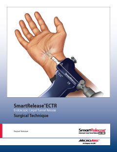 SmartRelease ECTR Surgical Technique